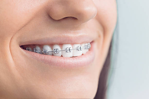 Dental Inlays and Onlays in Upland, CA